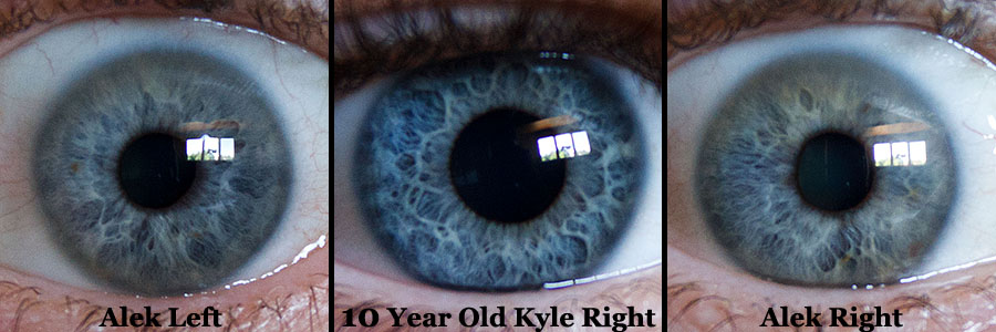 kyle right, alek left right cataract